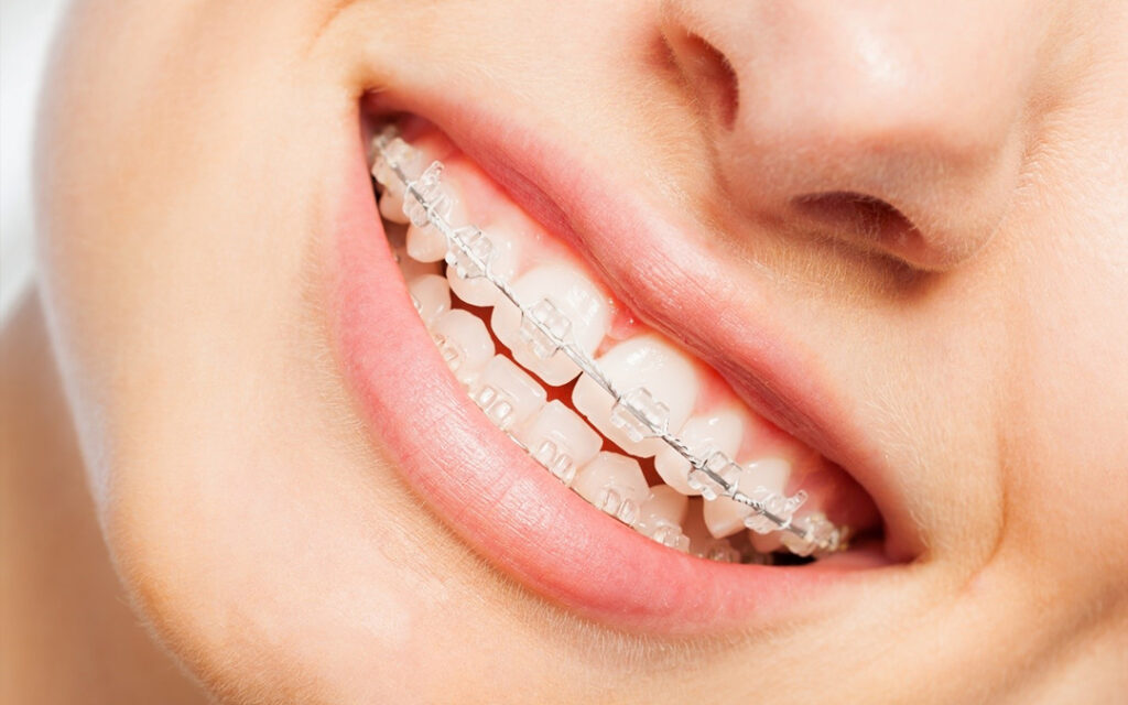 Traditional-Braces