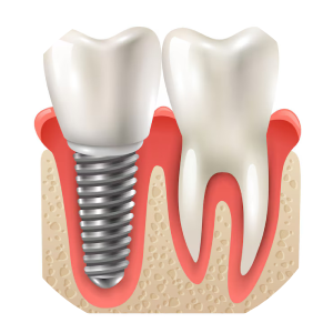 dental implant