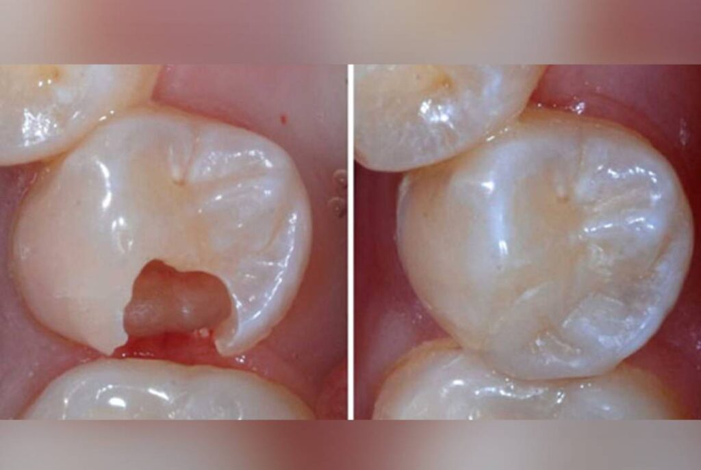 thumbnail image 2 of Dental Cavity Restoration Teeth Model - Decayed Tooth For Composite Resin Practice 2 of 6